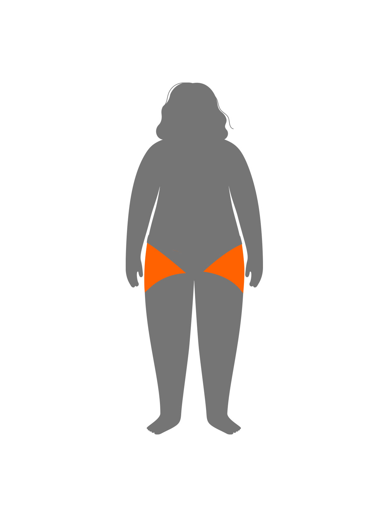 Lipedema