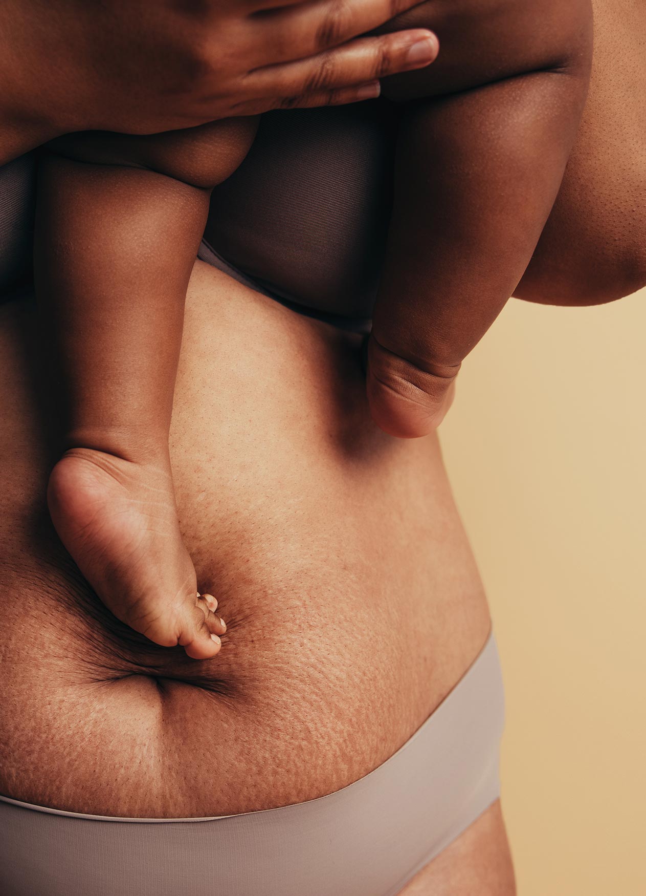 Lipedema